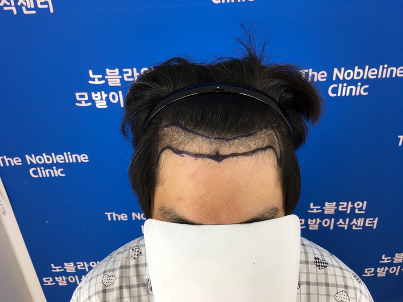 노블라인 M자 모발이식 100일 후기 입니다.