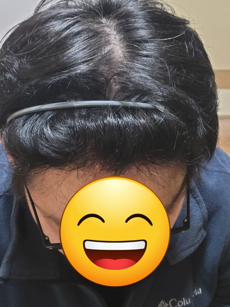 비절개 1200모냥 이식1년후 경과보고