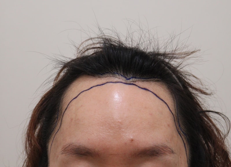 1. 수술전_1.JPG