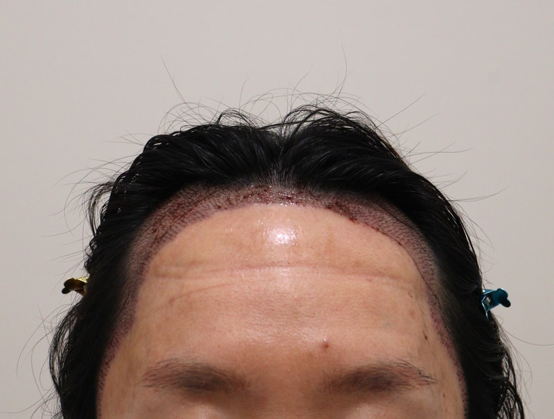 2. 수술후_1일_1.JPG