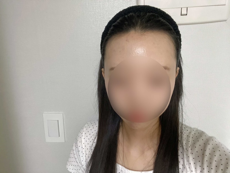 M자 이마 무삭발 비절개 헤어라인 1700모낭 모원성형외과 3달차