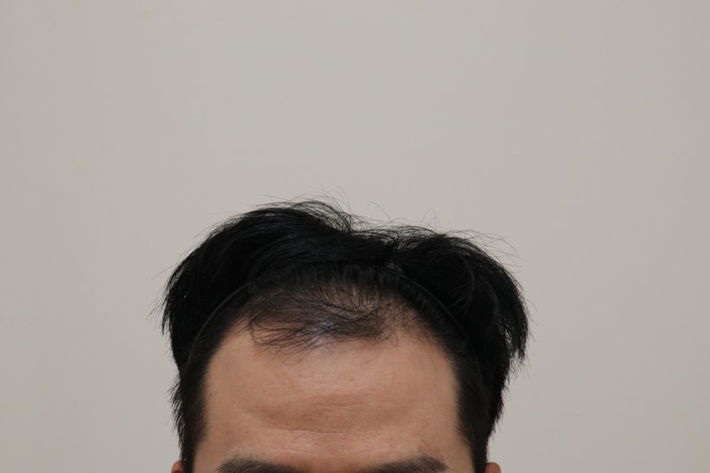 1. 수술전_1.JPG