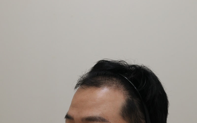 1. 수술전_2.JPG