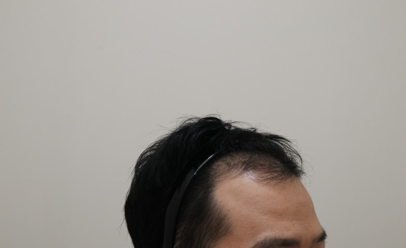 1. 수술전_3.JPG