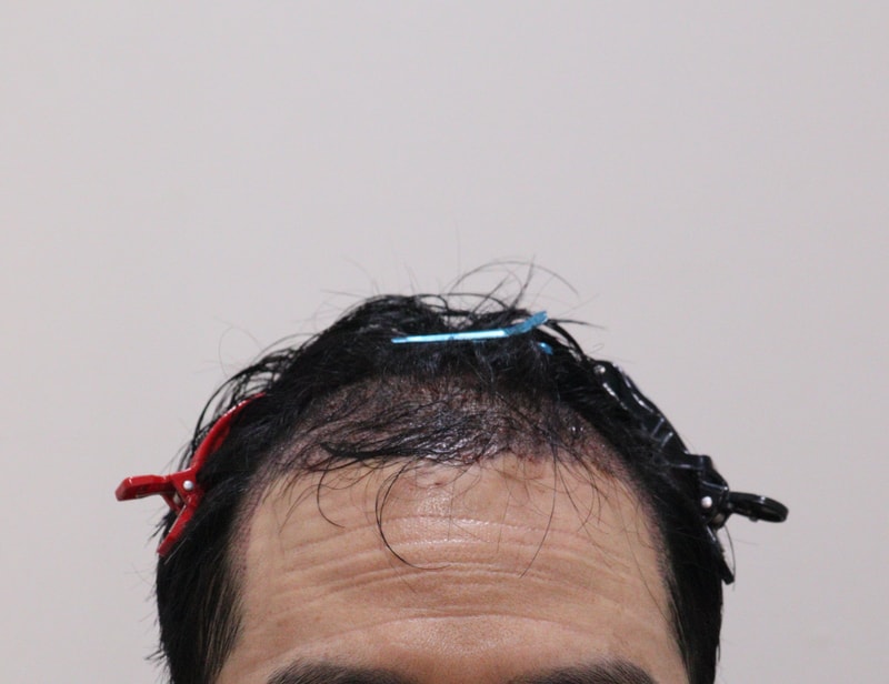 2. 수술후_1일_1.JPG