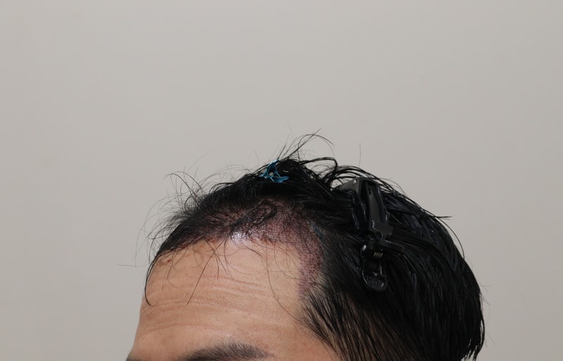 2. 수술후_1일_2.JPG