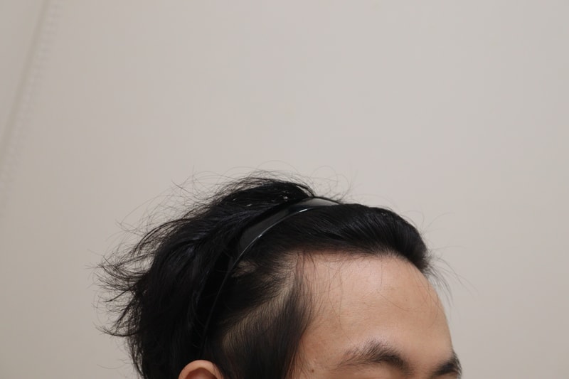 1. 수술전_3.JPG