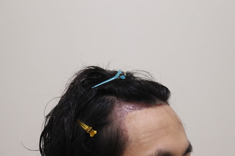 2. 수술후_1일_3.JPG