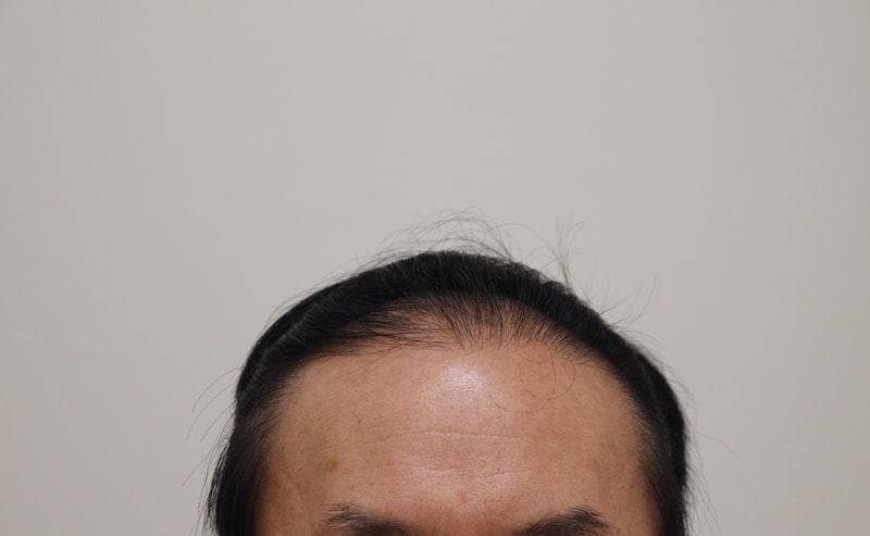 1. 수술전_1.JPG