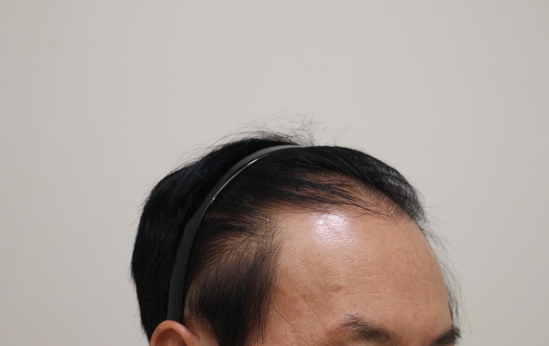 1. 수술전_3.JPG