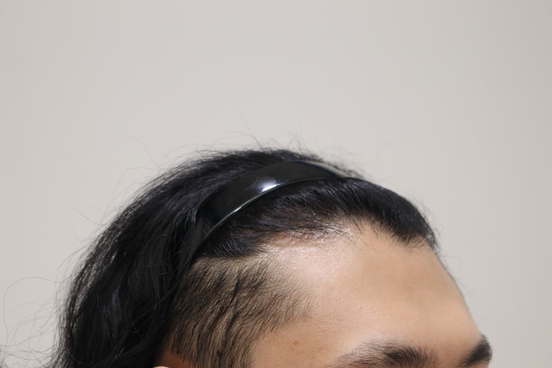 1. 수술전_3.JPG