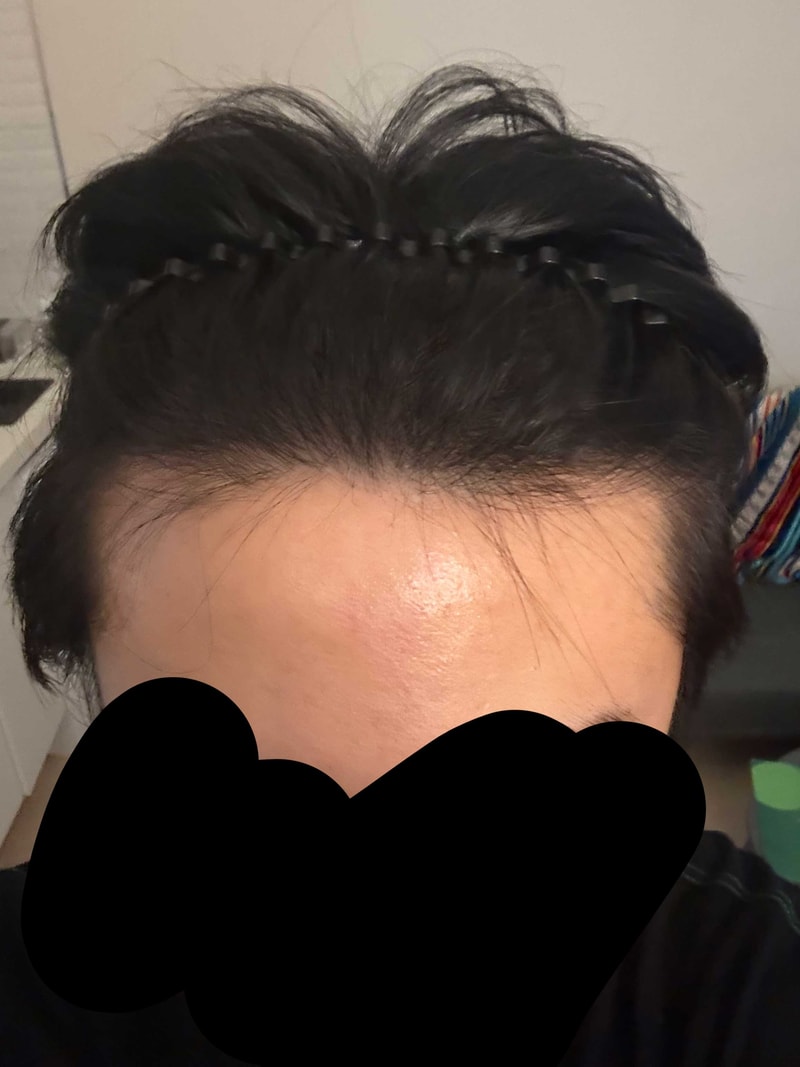 1000모낭으로 수북수북 가능했던 이유/다나성형외과/비절개/17개월