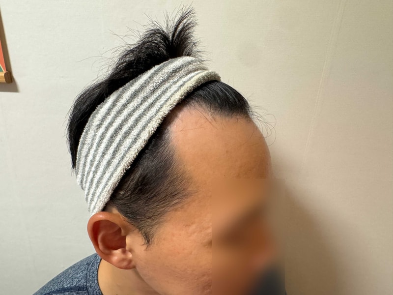 무삭발 비절개 헤어라인+정수리 2000모낭 모발이식 5일차 모원성형외과
