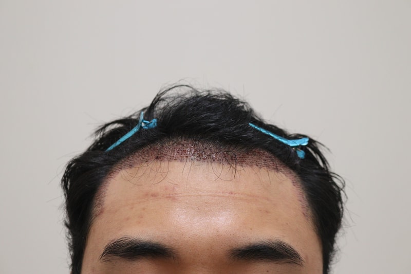 2. 수술후_1일_1.JPG