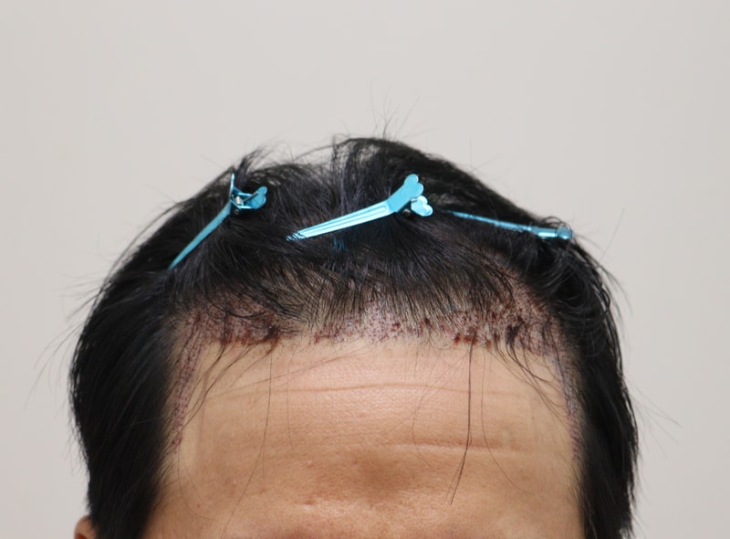 2. 수술후_1일_1.JPG