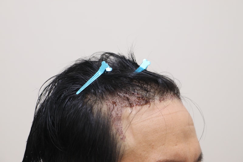 2. 수술후_1일_3.JPG