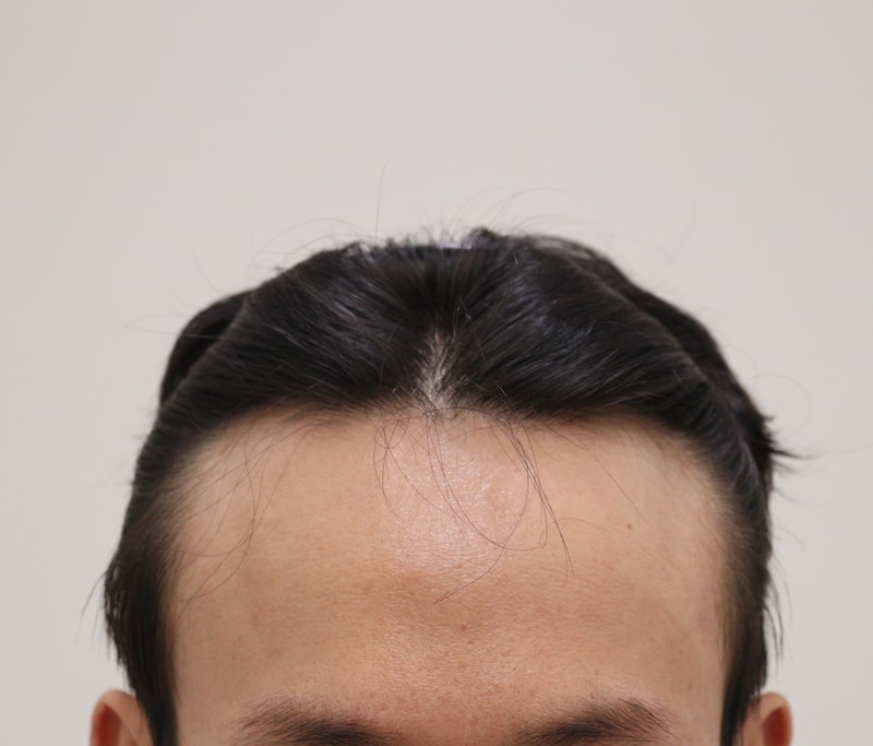 1. 수술전_1.JPG