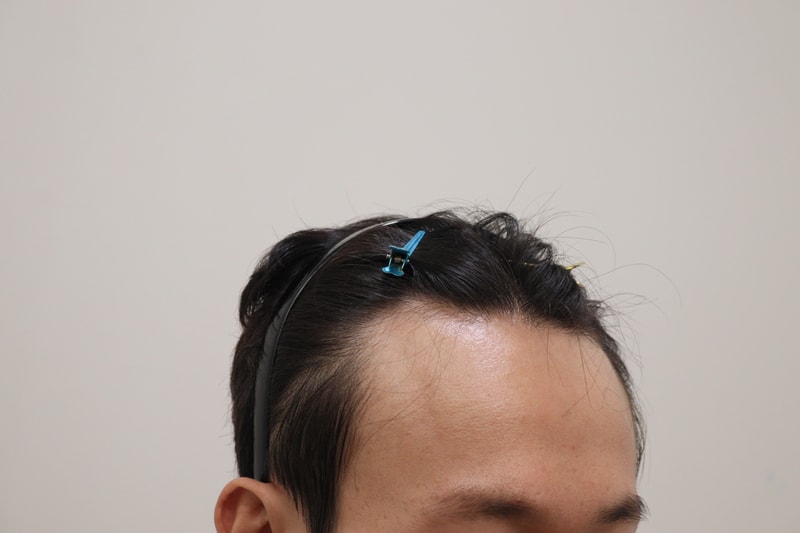 1. 수술전_3.JPG