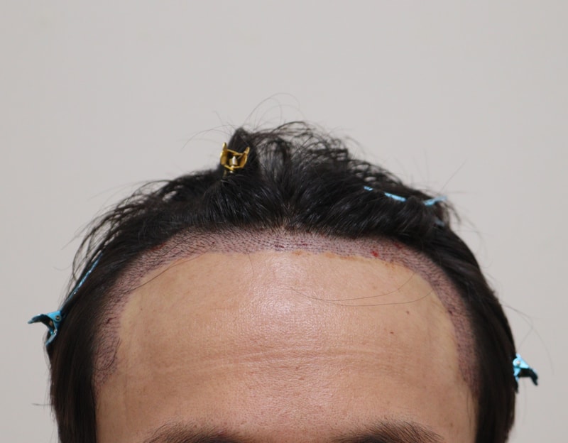 2. 수술후_1일_1.JPG