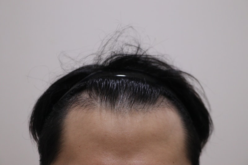 1. 수술전_1.JPG