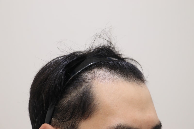1. 수술전_3.JPG