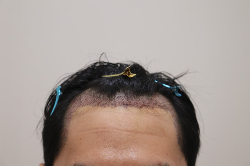2. 수술후_1일_1.JPG