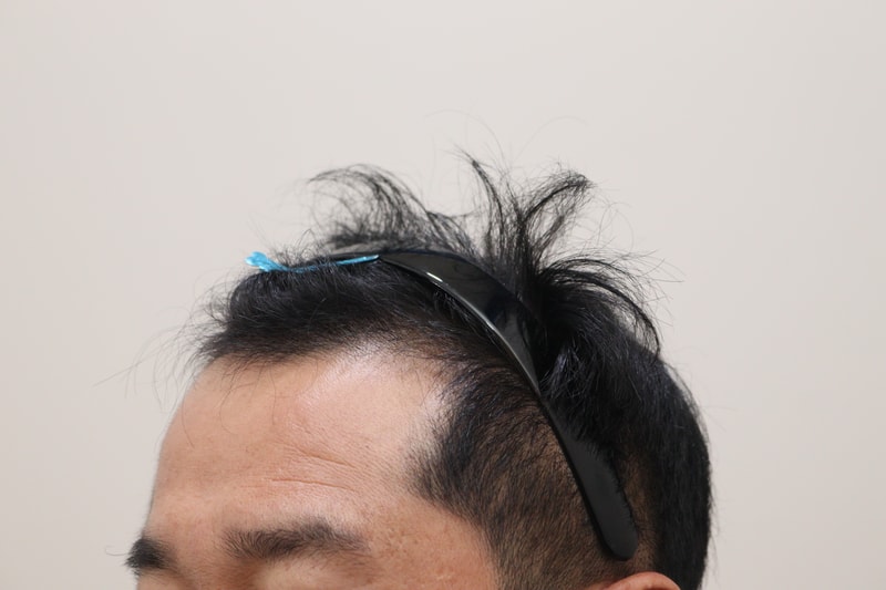 1. 수술전_2.JPG