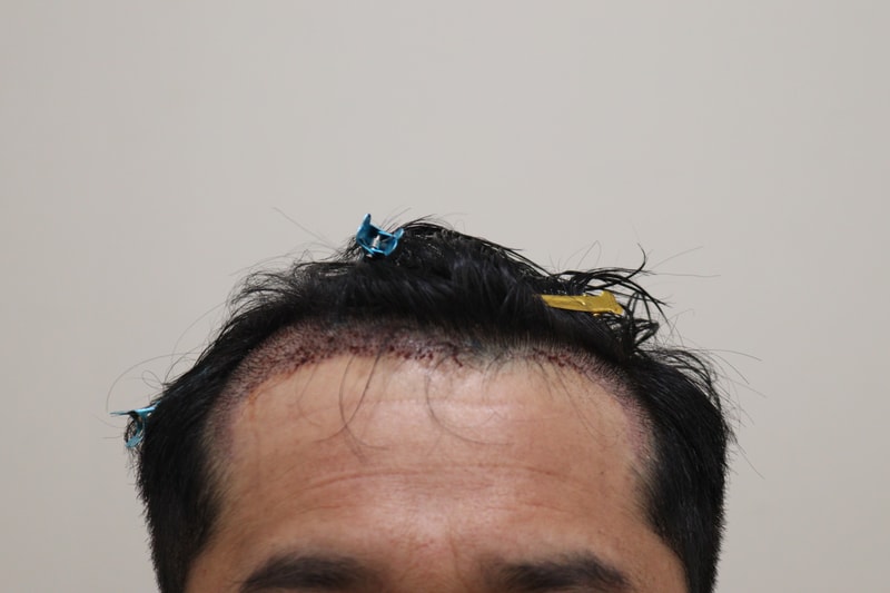 2. 수술후_1일_1.JPG