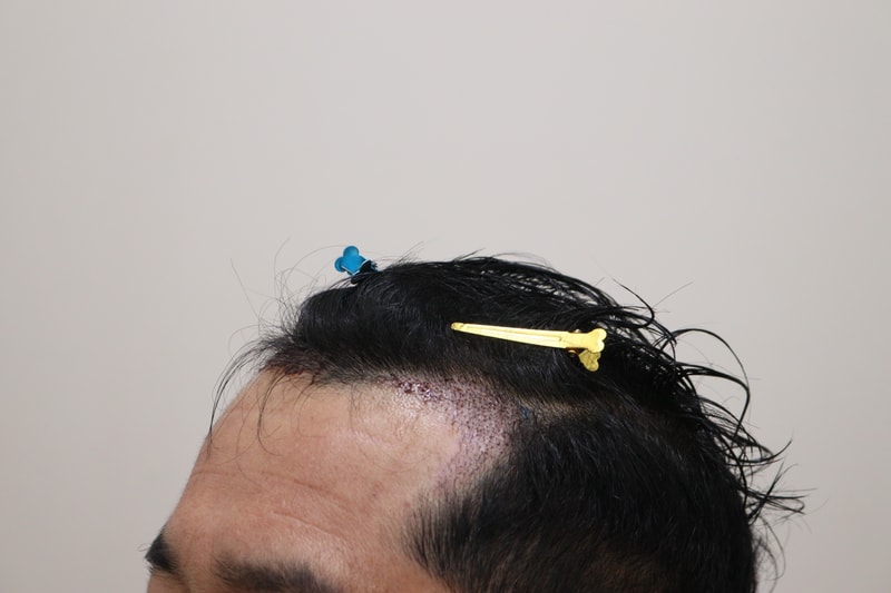 2. 수술후_1일_2.JPG