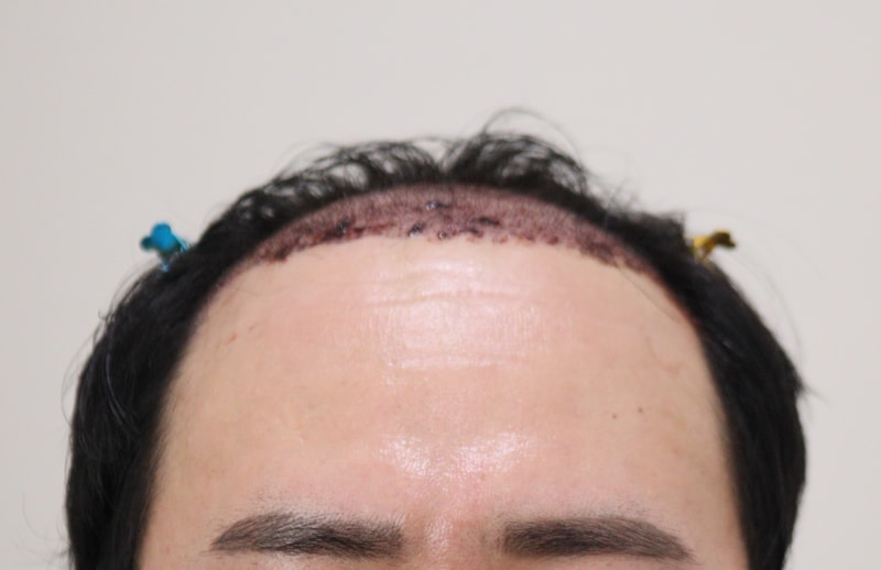 2. 수술후_1일_1.JPG