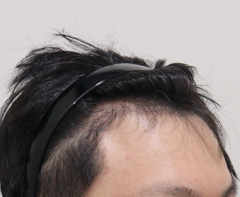 3. 수술후_6개월_3.JPG