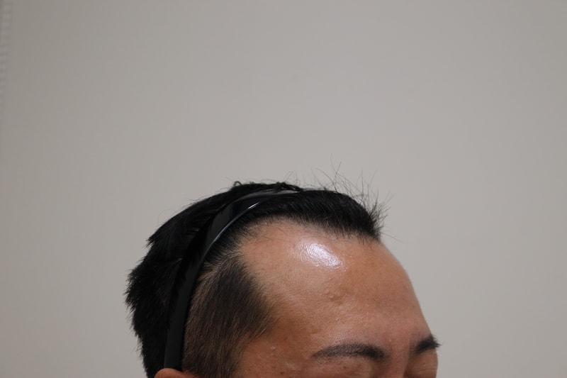 1. 수술전_3.JPG