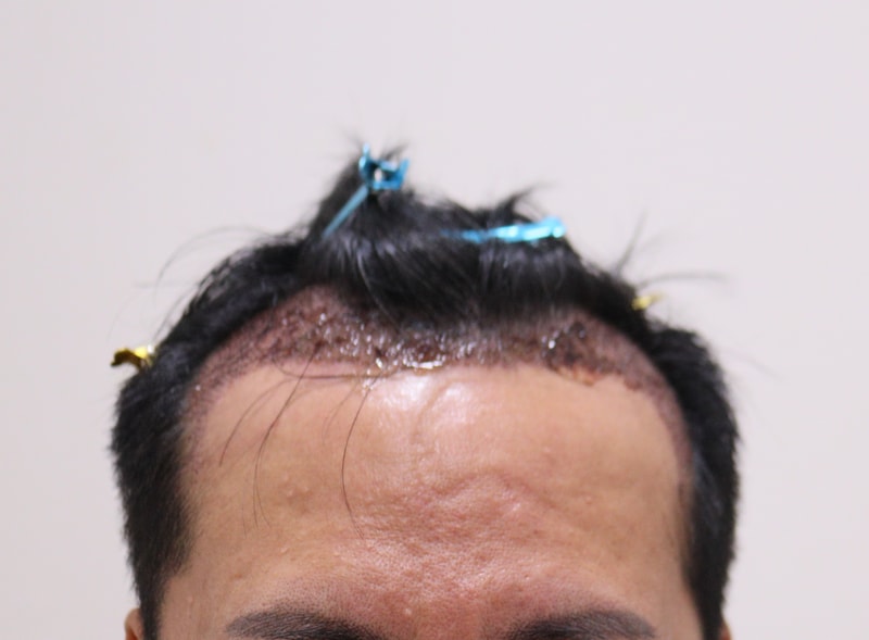 2. 수술후_1일_1.JPG