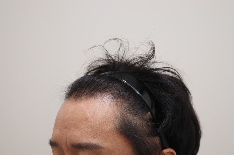 1. 수술전_2.JPG