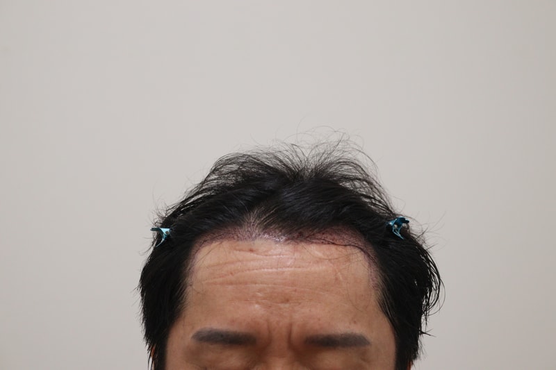2. 수술후_1일_1.JPG