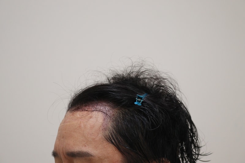 2. 수술후_1일_2.JPG