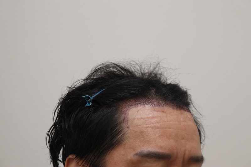 2. 수술후_1일_3.JPG