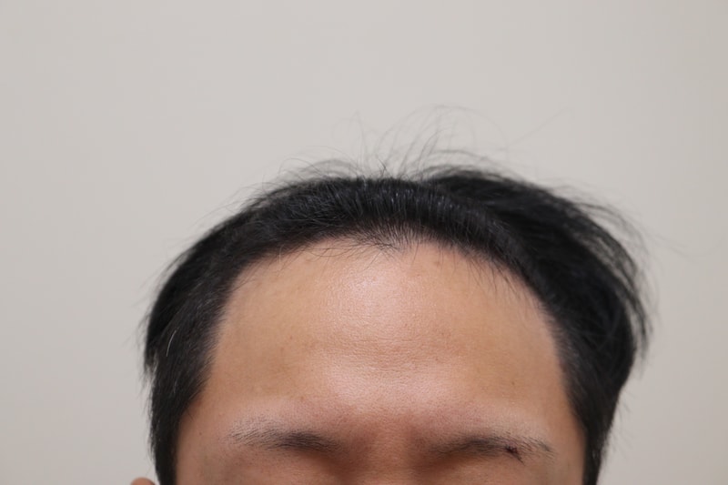 1. 수술전_1.JPG