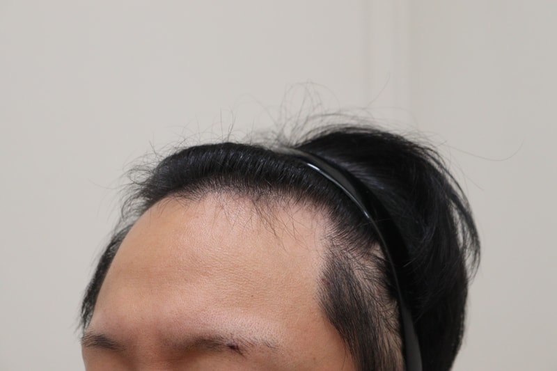 1. 수술전_2.JPG