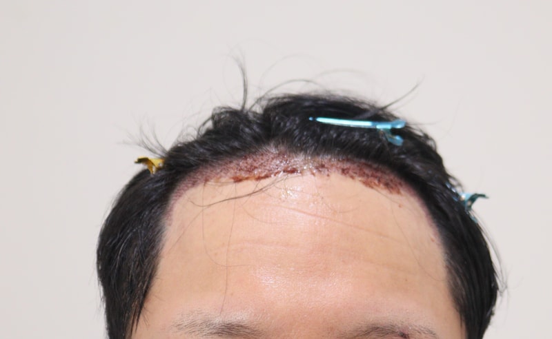 2. 수술후_1일_1.JPG