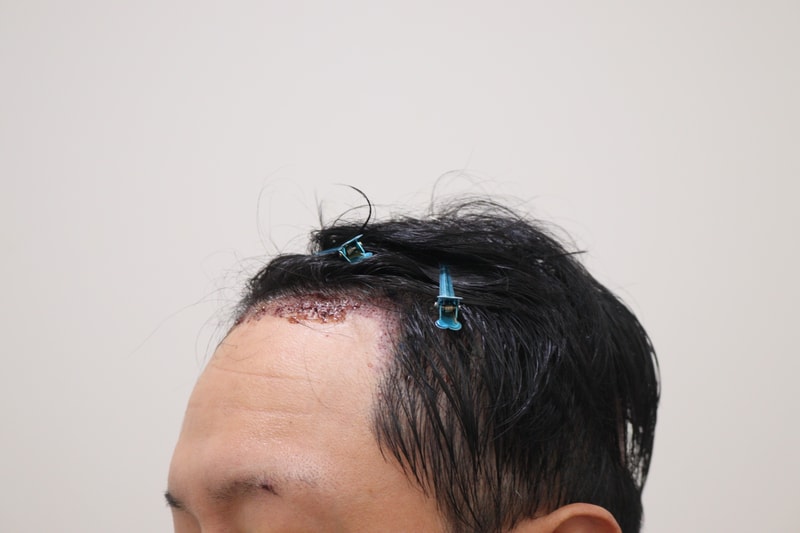 2. 수술후_1일_2.JPG