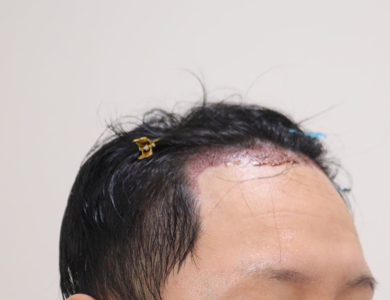 2. 수술후_1일_3.JPG
