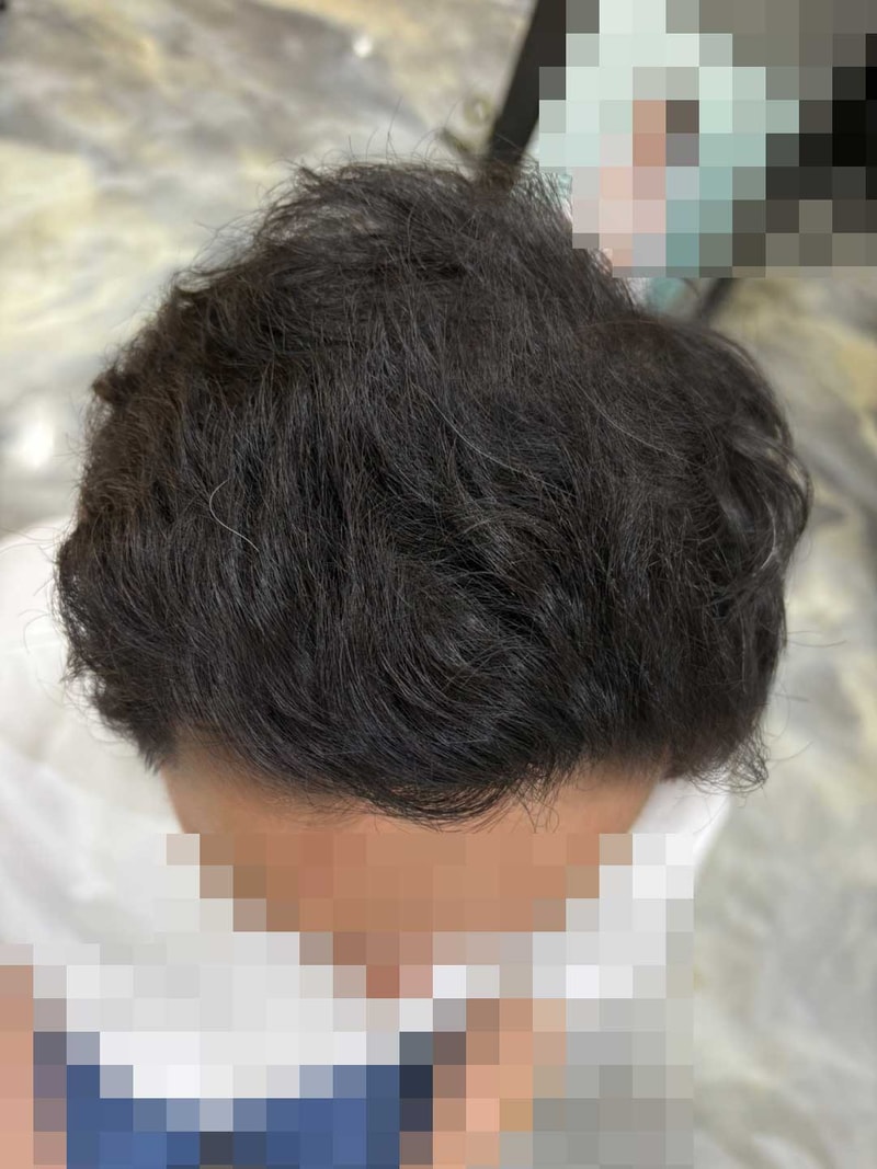다나성형외과모발이식.jpg