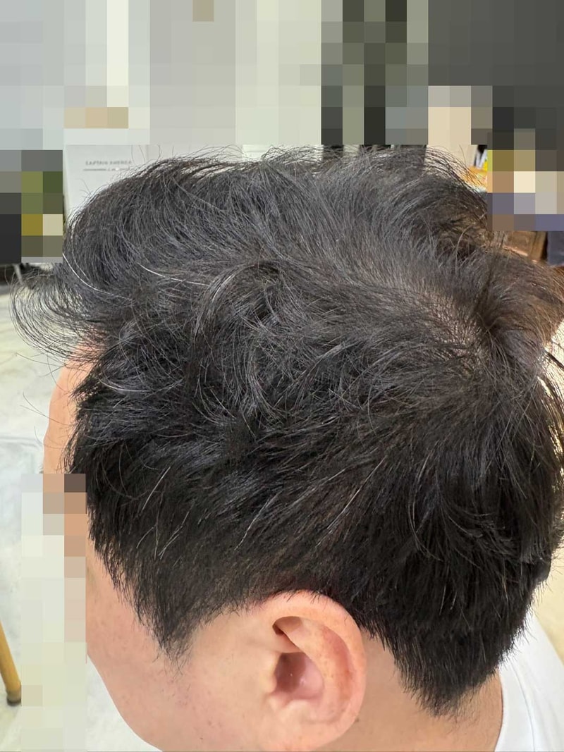 다나성형외과비절개모발이식후9개월.jpg