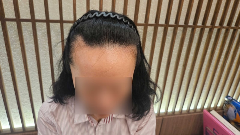 여자 M자이마 1900모낭 비절개 모발이식 모원성형외과 3일차