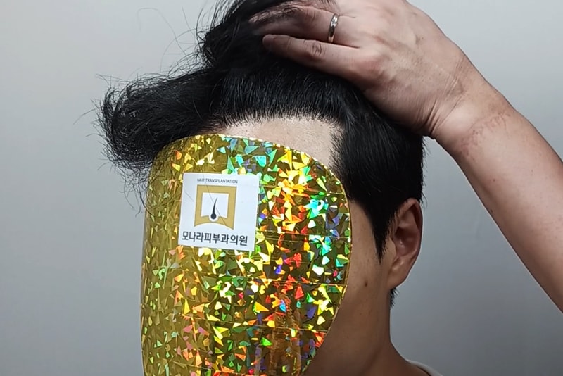 모나라모발이식1년 (4).jpg