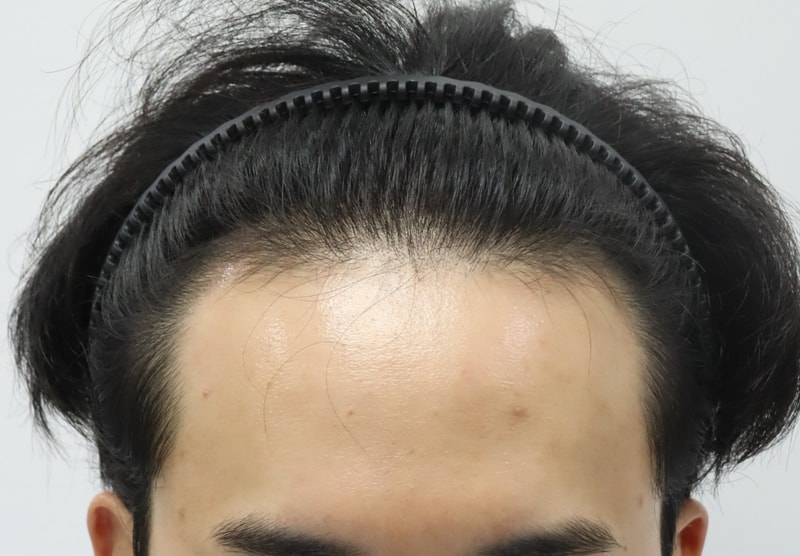 압구정 포헤어의원 M자탈모 비절개슬릿 채취 후 실시간 모발이식 수술당일 후기