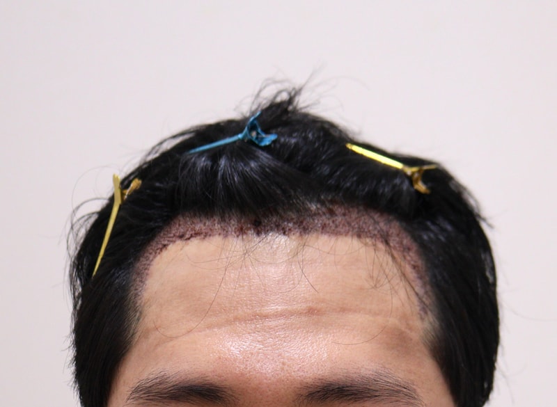 2. 수술후_1일_1.JPG