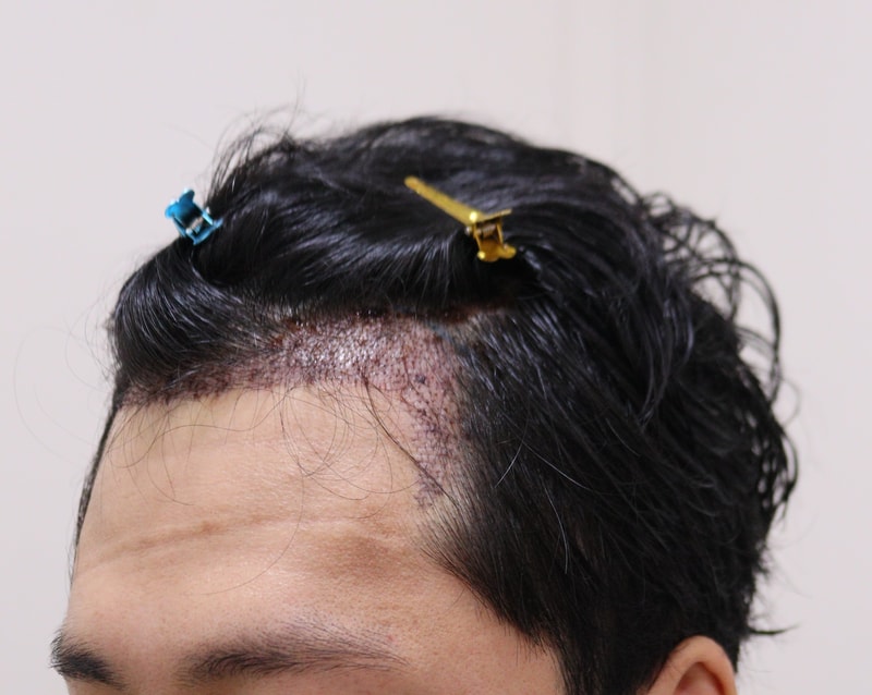 2. 수술후_1일_2.JPG