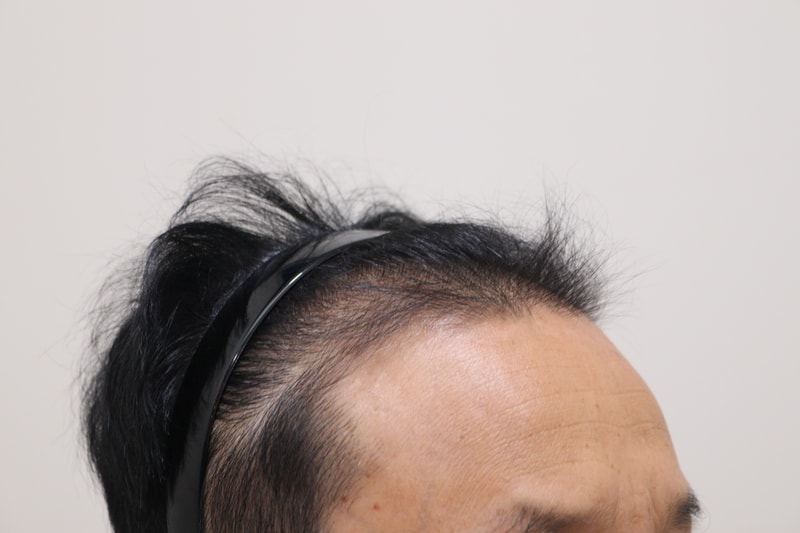 1. 수술전_3.JPG